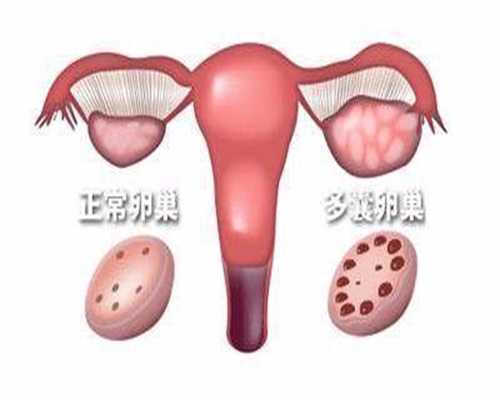 广州代孕好不好：宫颈炎会带来什么危害呢