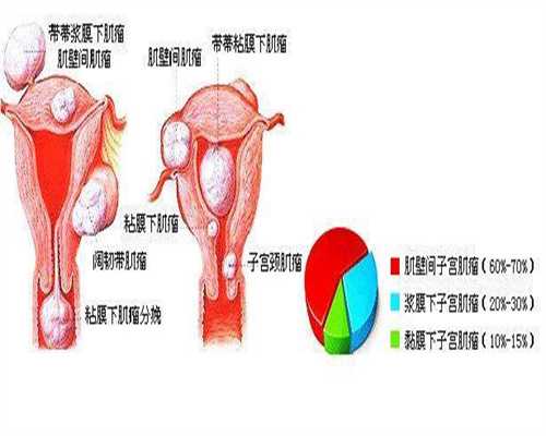 武汉代孕:多囊卵巢综合症的原因是什么