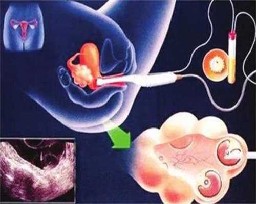 中国代孕合法吗，有卵巢囊肿、盆腔积液和宫颈